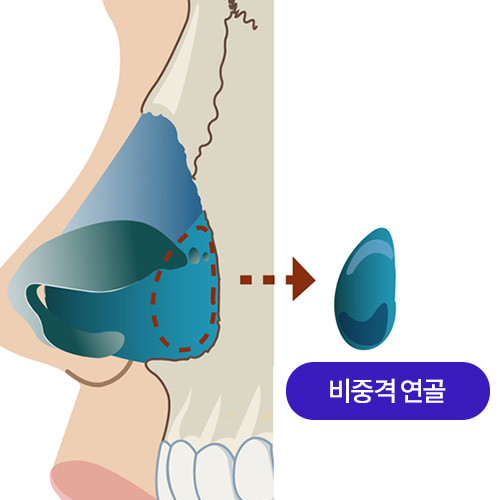 비중격연골