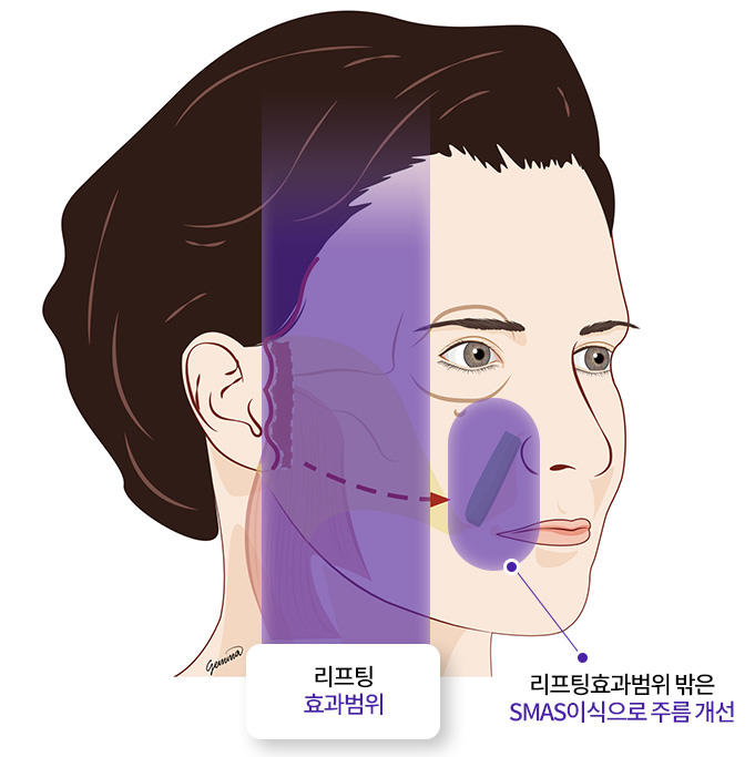 리프팅/안면거상술