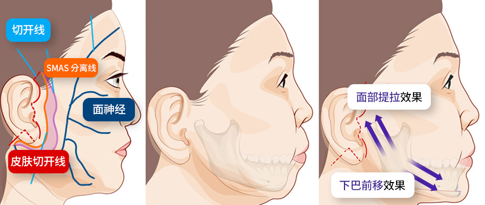 리프팅/안면거상술