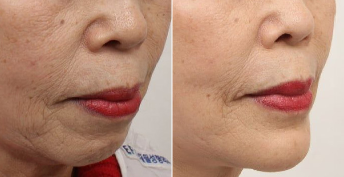 수술 전후 비교