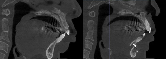 수술 전후 비교