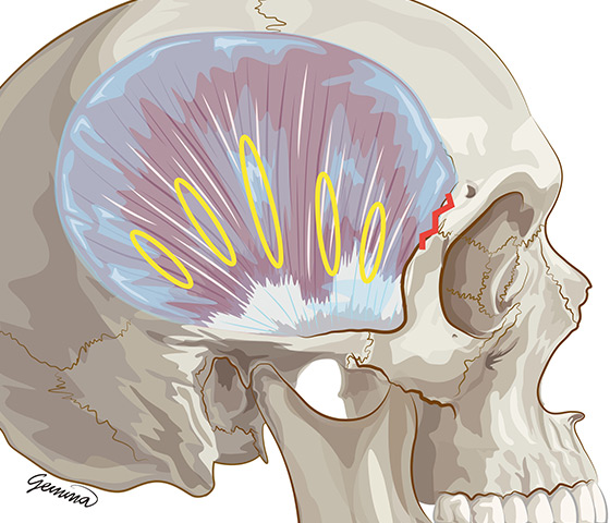 눈썹 속으로 절개