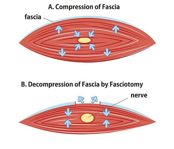 근육과 신경 직접 분리
