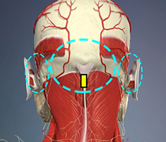 뒷목 주름 절개