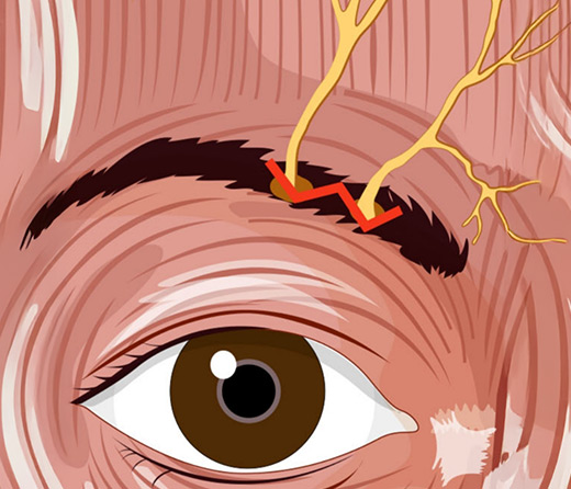 즉각적인 통증 완화 효과